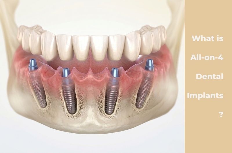 All on 4 dental implants before and after Turkey Antalya
